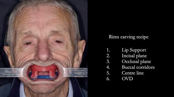Newsletter 80 - Gordon’s dentures: the one case in 1,000 where my technique failed
