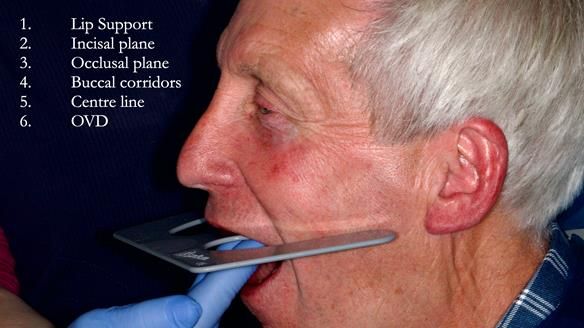 Newsletter 77: Jeremy’s case – immediate complete upper denture