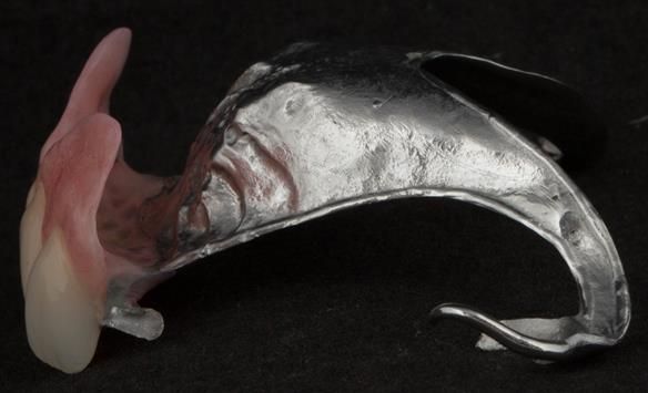 Figure 74 Finished upper definitive partial denture with knife edge flange - replacing the missing gum tissue. Anterior path of insertion to give retention