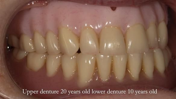 Newsletter 75: Marion’s case - Step-by-step complete denture workflow