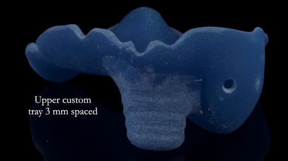 Newsletter 55 Provision of metal based partial dentures for Zephyrine with a repaired cleft lip and palate