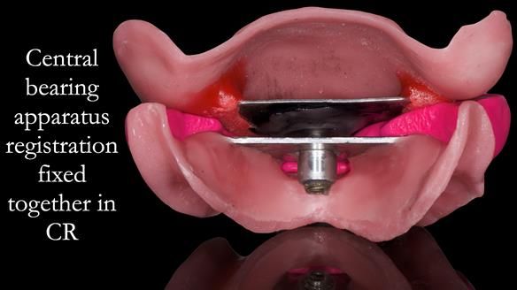 Newsletter 52 Managing Jo’s failing dentition with extractions and Mk 1/Mk 2 complete upper dentures and lower partial dentures FULL PROTOCOL