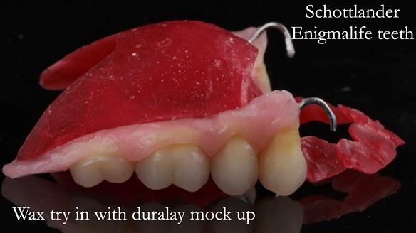 Newsletter 56 showing the making and fitting of a bilateral free end saddle upper removable partial denture (RPD) for patient with pemphigus