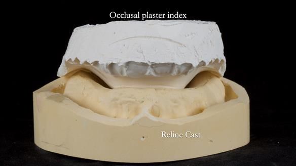 Newsletter 54 case presentation upper complete denture and lower Scandinavian designed hygienic partial denture for David