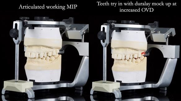 Finlay's Newsletter 64 case study - provision of a Kennedy class 2 metal based Scandinavian RPD for Ian