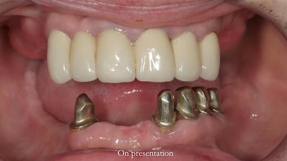 Newsletter 76: Jackie’s case – Telescopic overdenture & precision RPD (the tricky truth!)