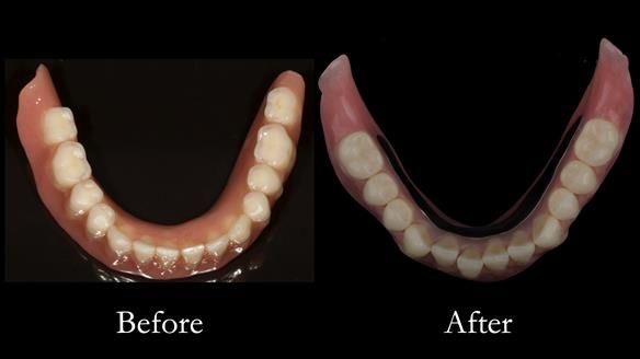 After - optimally border moulded to the functionally depth and width of the suli - giving optimal support to the dentures, not being overly reliant on the implants.