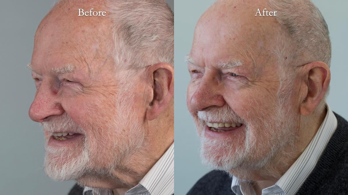 Newsletter 87 – Father Peter: A Partial Denture that needed Minor Miracle