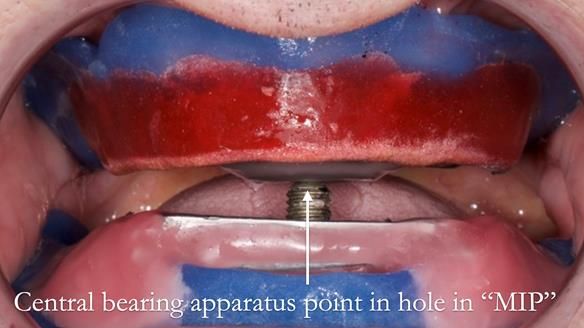 Newsletter 80 - Gordon’s dentures: the one case in 1,000 where my technique failed