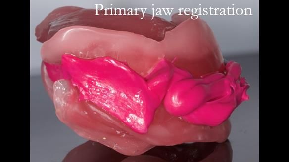 Managing poor implant positioning with complete dentures and Locator attachments - full protocol Newsletter 41