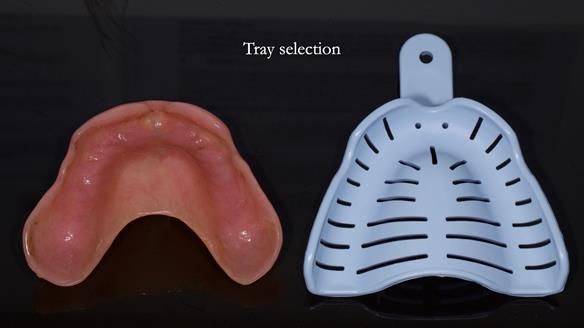 Newsletter 78: What do Clark Gable and a Locator® overdenture have in common?