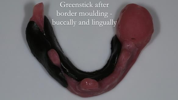 Finlay's Newsletter 59 Ultra hard partial dentures made for Gill