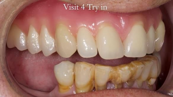 Newsletter 54 case presentation upper complete denture and lower Scandinavian designed hygienic partial denture for David