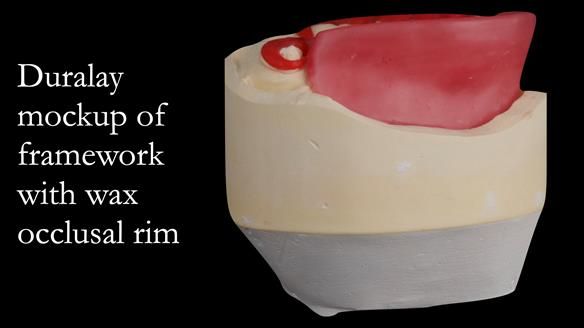 Upper metal base partial denture/occlusal stabilisation splint/obturator - full protocol