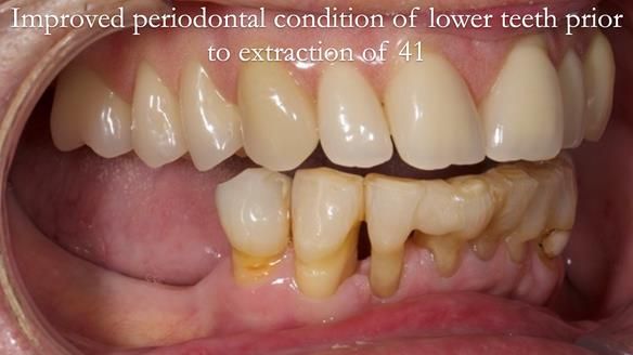 Newsletter 54 case presentation upper complete denture and lower Scandinavian designed hygienic partial denture for David