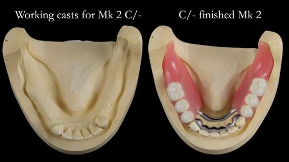 Newsletter 52 Managing Jo’s failing dentition with extractions and Mk 1/Mk 2 complete upper dentures and lower partial dentures FULL PROTOCOL