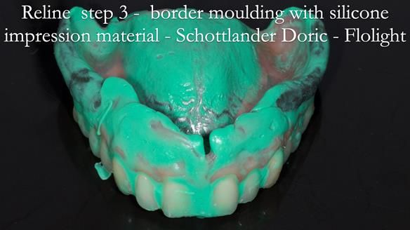 Newsletter 54 case presentation upper complete denture and lower Scandinavian designed hygienic partial denture for David