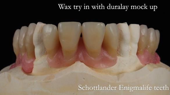 Finlay's Newsletter 59 Ultra hard partial dentures made for Gill