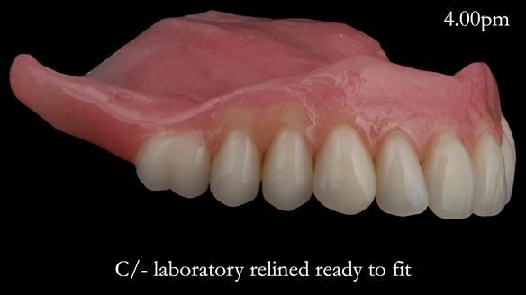 Newsletter 52 Managing Jo’s failing dentition with extractions and Mk 1/Mk 2 complete upper dentures and lower partial dentures FULL PROTOCOL