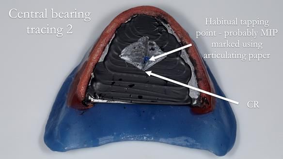 Newsletter 80 - Gordon’s dentures: the one case in 1,000 where my technique failed