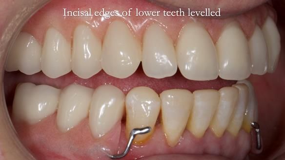 Newsletter 52 Managing Jo’s failing dentition with extractions and Mk 1/Mk 2 complete upper dentures and lower partial dentures FULL PROTOCOL