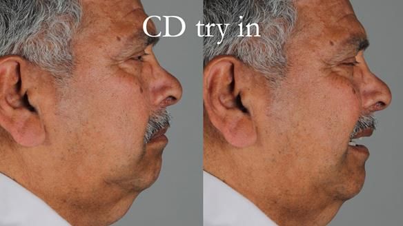 Finlay's Newsletter 62 provision of extractions and metal based complete dentures for Rafique