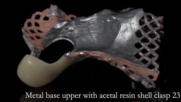 Newsletter 55 Provision of metal based partial dentures for Zephyrine with a repaired cleft lip and palate