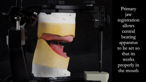 Complete denture Class II div 2 deep overbite Newsletter 39