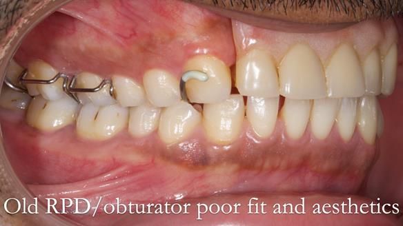 Acrylic based partial denture/obturator had poor, retention and support Obturator section was in poor condition. The Adams clasp were causing inflammation of the gingival margins. The clasp on the UR3 was visible resulting in poor appearance. Reduced lip
