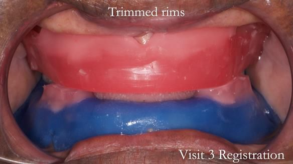 Newsletter 53 showing the making and fitting of ultra life-like dentures for Valena