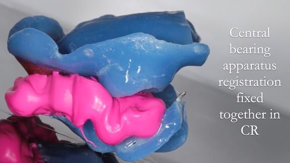 Finlay's Newsletter 58 Gasket upper partial denture for Zoe