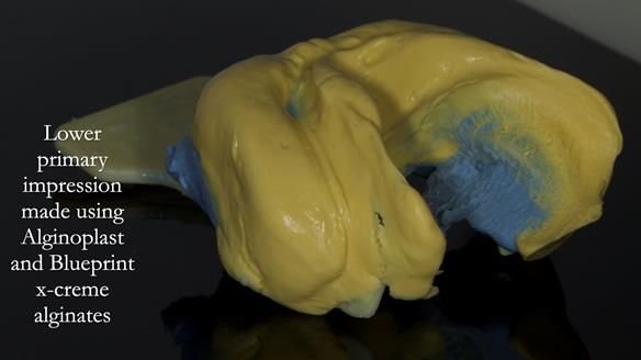 Newsletter 83: Sheila’s Complete Denture Success
