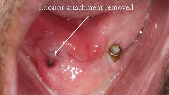 Managing poor implant positioning with complete dentures and Locator attachments - full protocol Newsletter 41