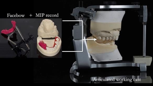 Finlay's Newsletter 61 provision of a lower unilateral free end saddle metal based partial denture for Joyce