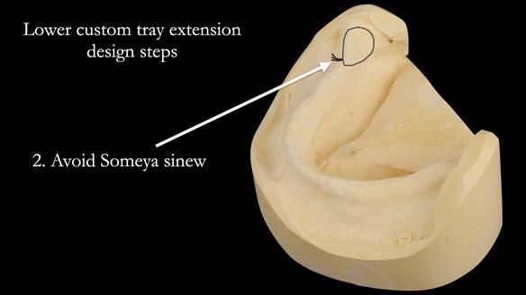 Newsletter 50 Special edition Complete Dentures FULL PROTOCOL