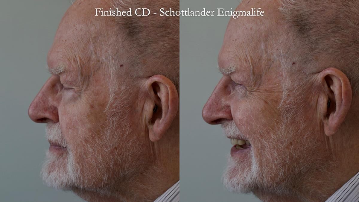 Newsletter 87 – Father Peter: A Partial Denture that needed Minor Miracle