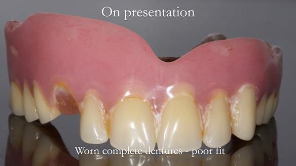 Newsletter 57 showcases the making and fitting process of implant-supported complete dentures for Alisdair