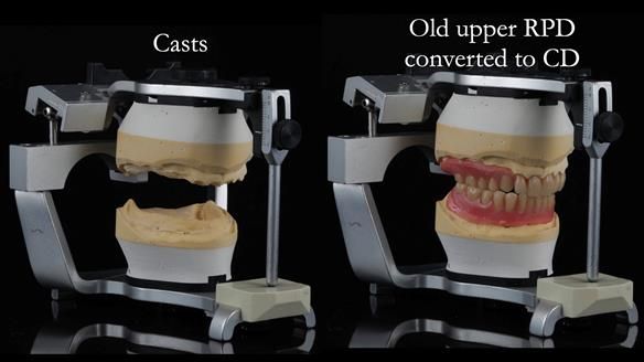 Finlay's Newsletter 62 provision of extractions and metal based complete dentures for Rafique