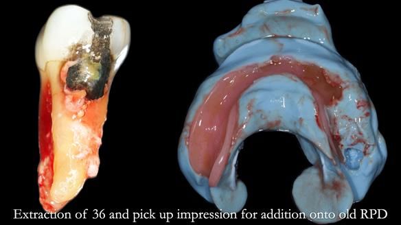 Finlay's Newsletter 59 Ultra hard partial dentures made for Gill
