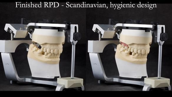 Solving Sue's failed implants with metal based RPD - full protocol Newsletter 43