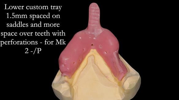 Newsletter 54 case presentation upper complete denture and lower Scandinavian designed hygienic partial denture for David