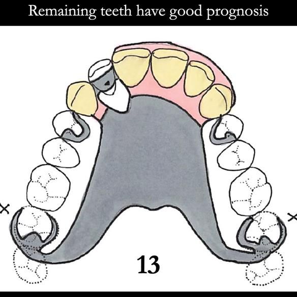 Universal Scandinavian partial denture designs