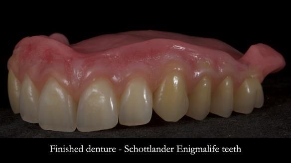 Newsletter 83: Sheila’s Complete Denture Success