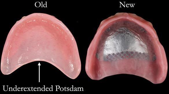 Managing poor implant positioning with complete dentures and Locator attachments - full protocol Newsletter 41
