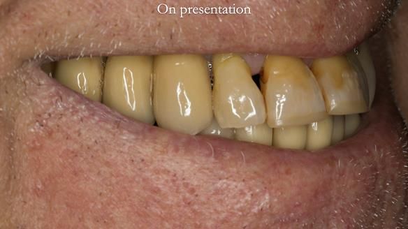 Ken – going downhill, first class