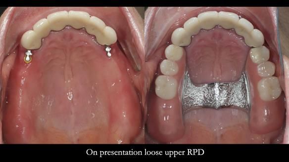 Newsletter 76: Jackie’s case – Telescopic overdenture & precision RPD (the tricky truth!)