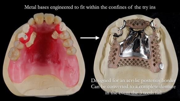 Finlay's Newsletter 59 Ultra hard partial dentures made for Gill