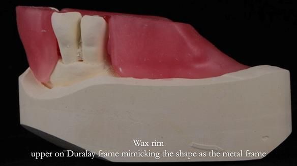 Finlay's Newsletter 59 Ultra hard partial dentures made for Gill