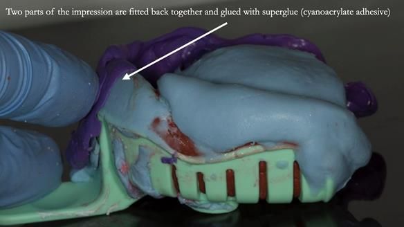 Finlay's Case Study Newsletter 40 - Immediate Mk 1 RPD to Definitive Mk 2 RPD - full protocol