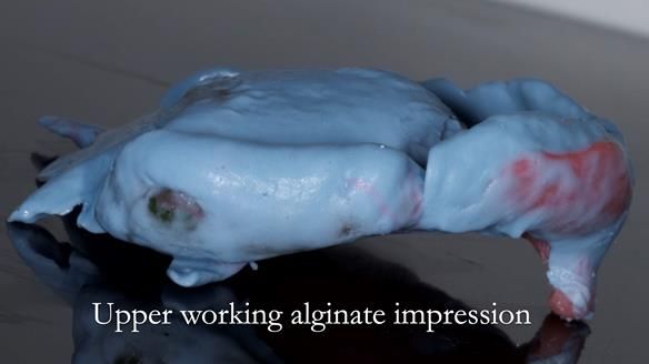 Complete denture Class II div 2 deep overbite Newsletter 39